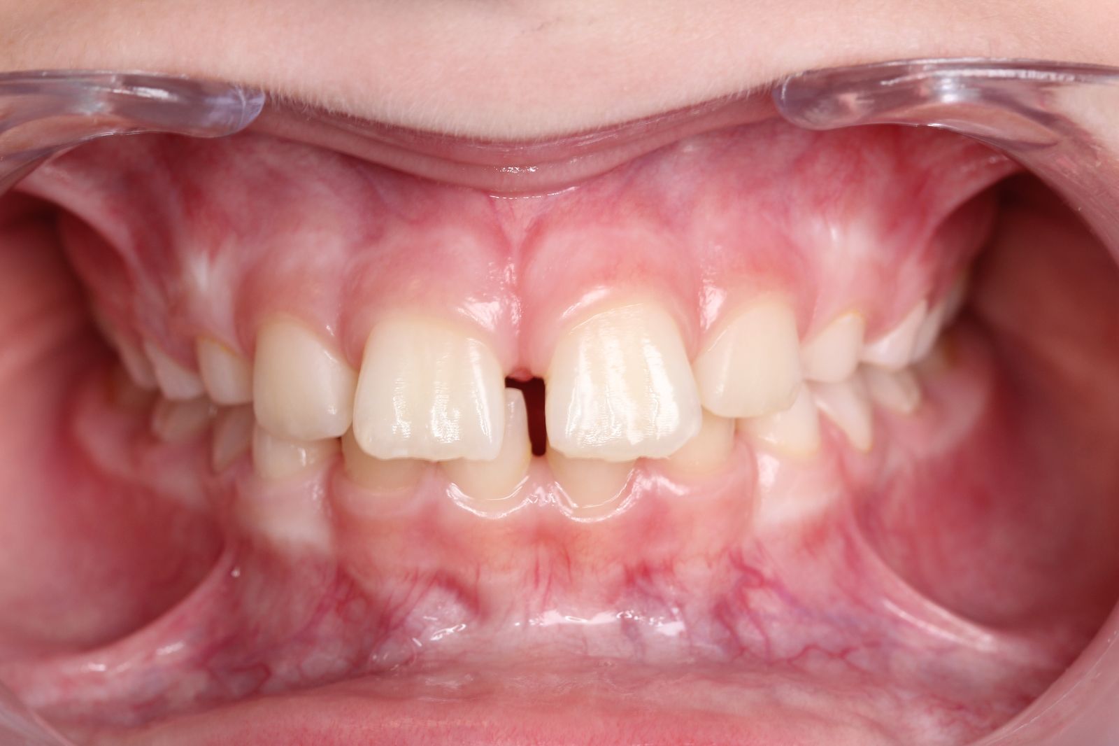 Segmentinis gydymas — prieš