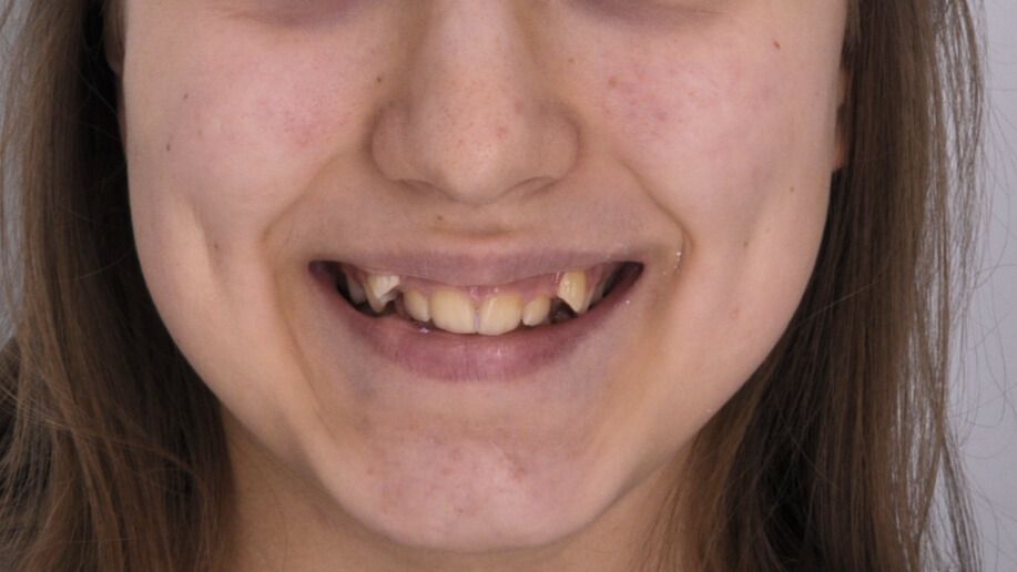 Breketai — atvejis 1