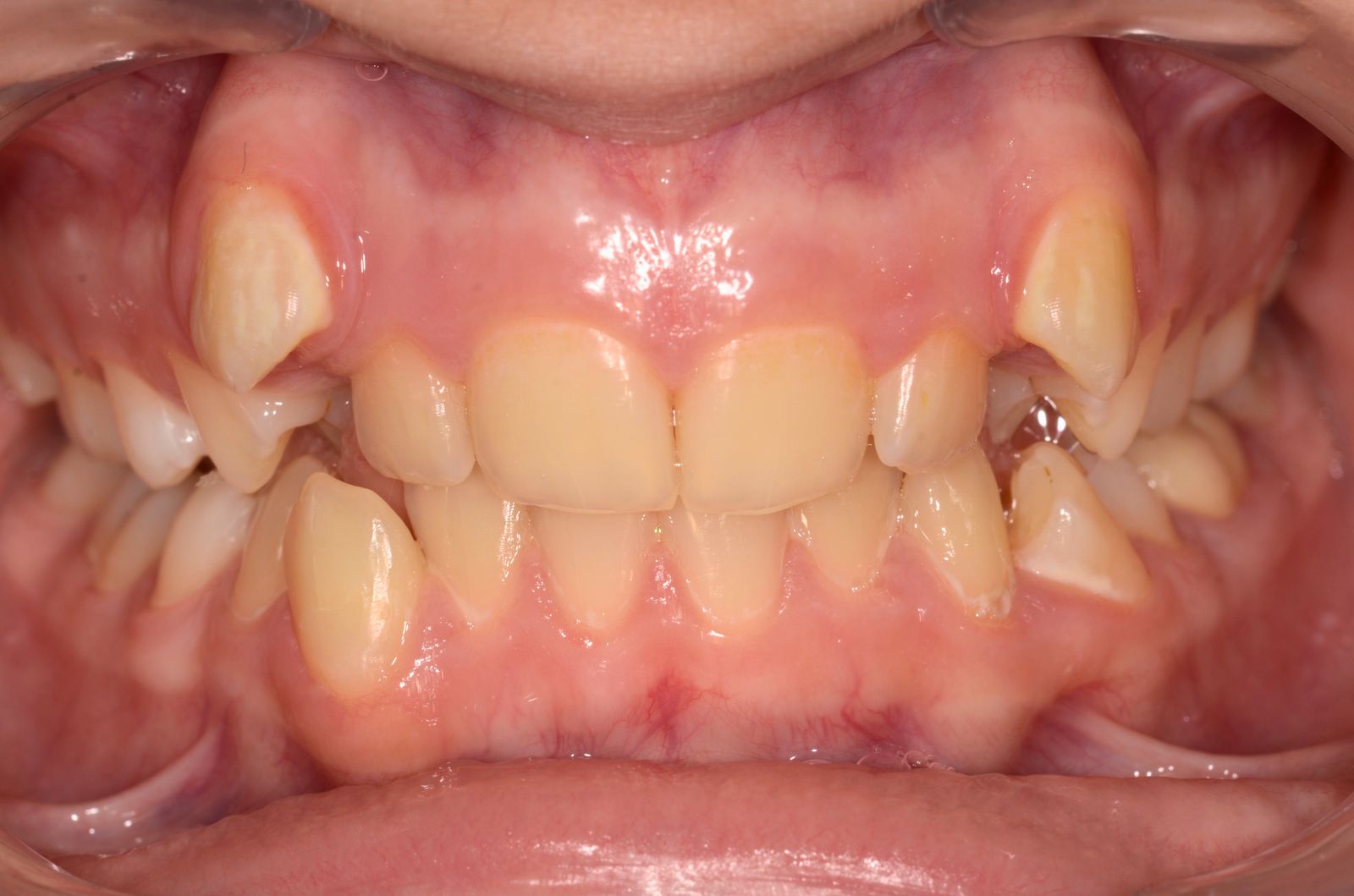 Breketai — atvejis 1