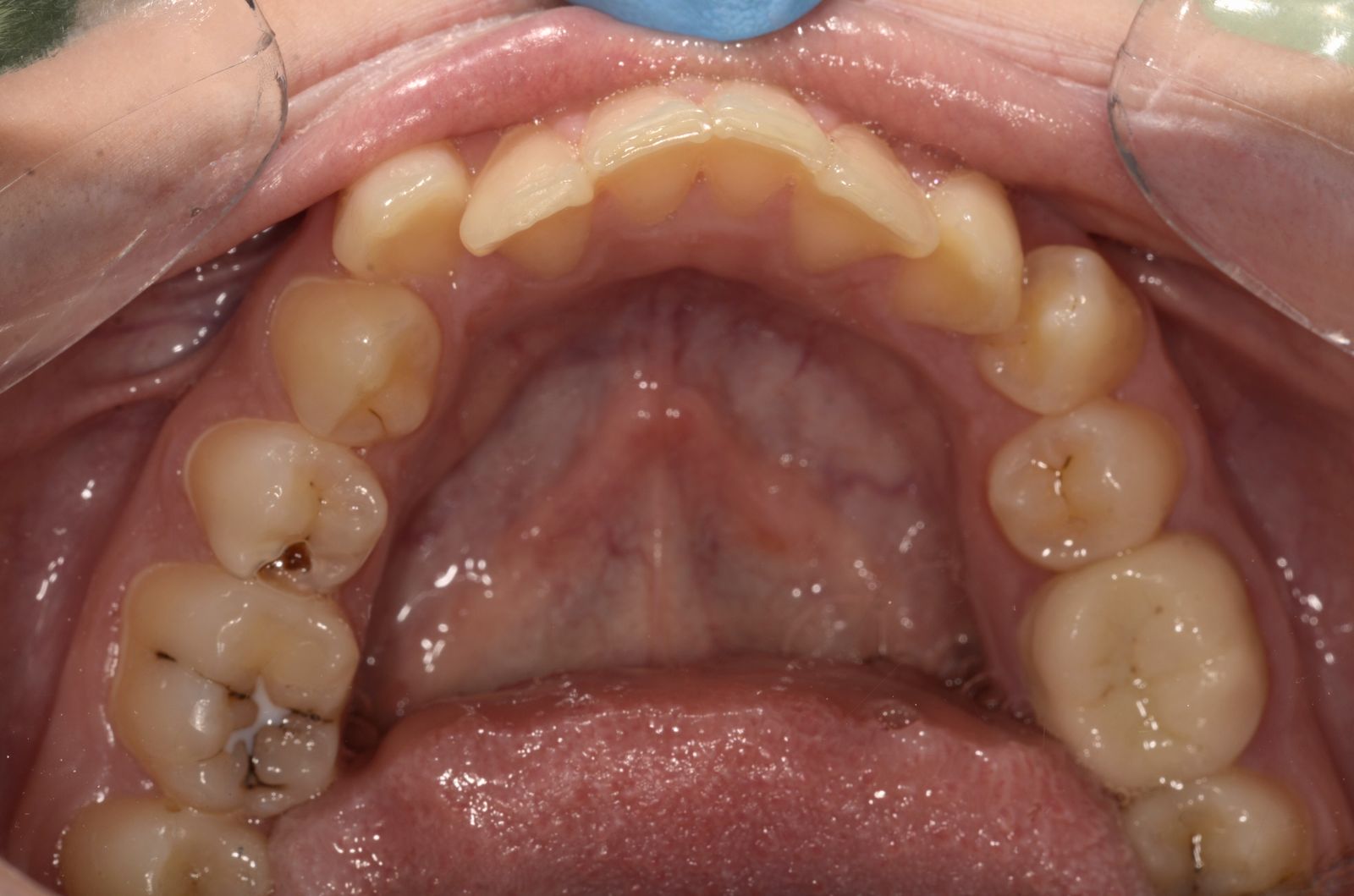 Breketai — atvejis 1