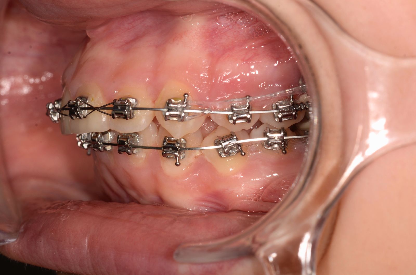 Breketai — atvejis 1