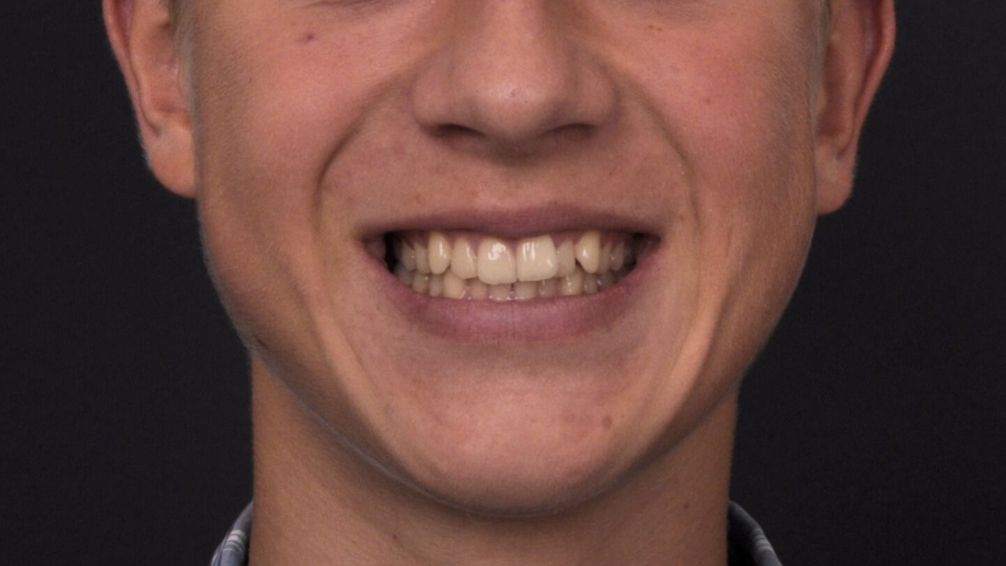 Breketai — atvejis 8