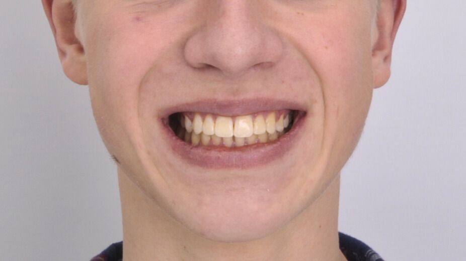 Breketai — atvejis 8