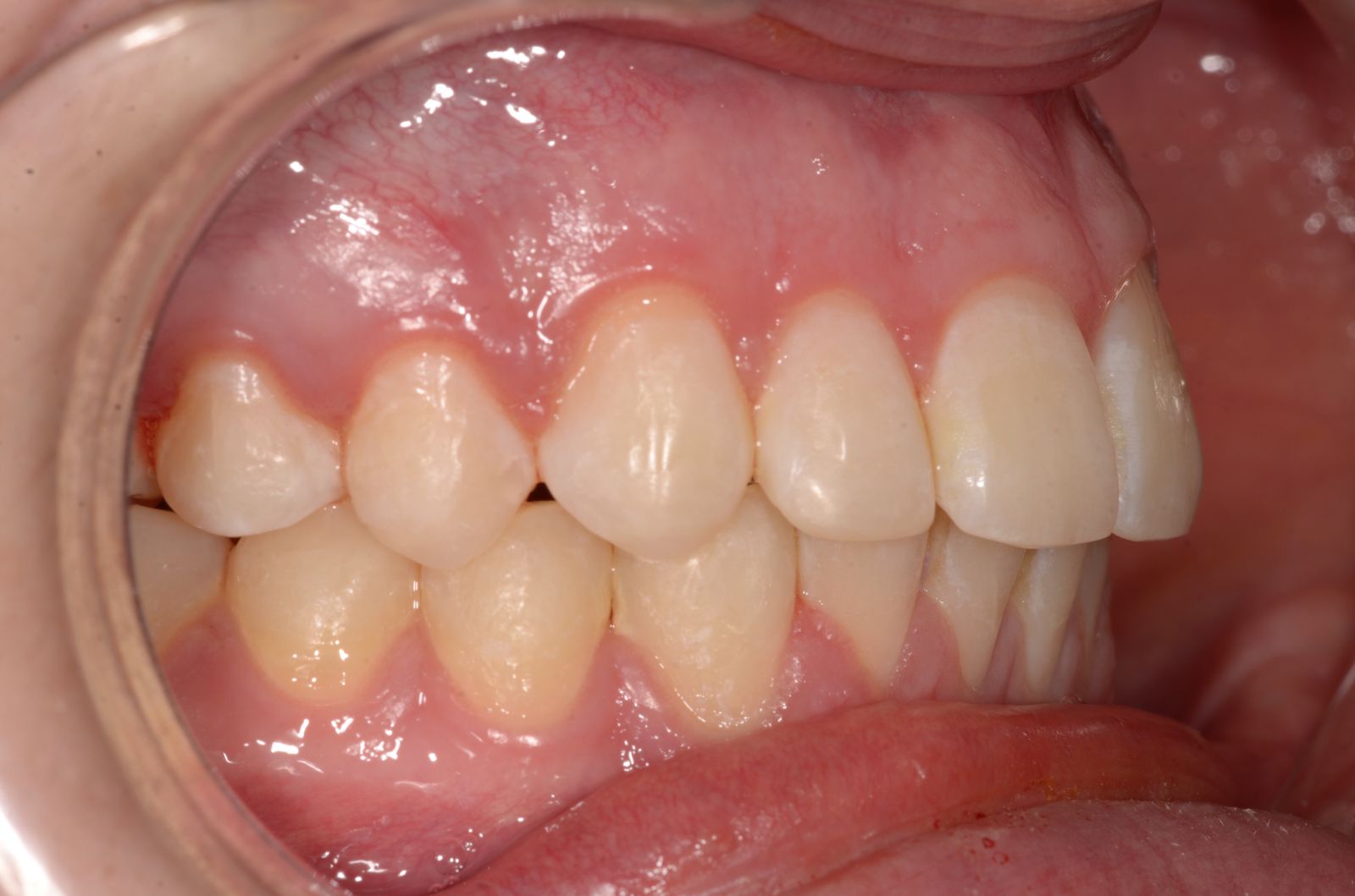 Breketai — atvejis 8