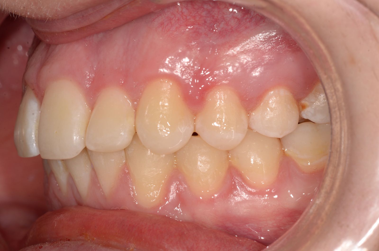 Breketai — atvejis 8