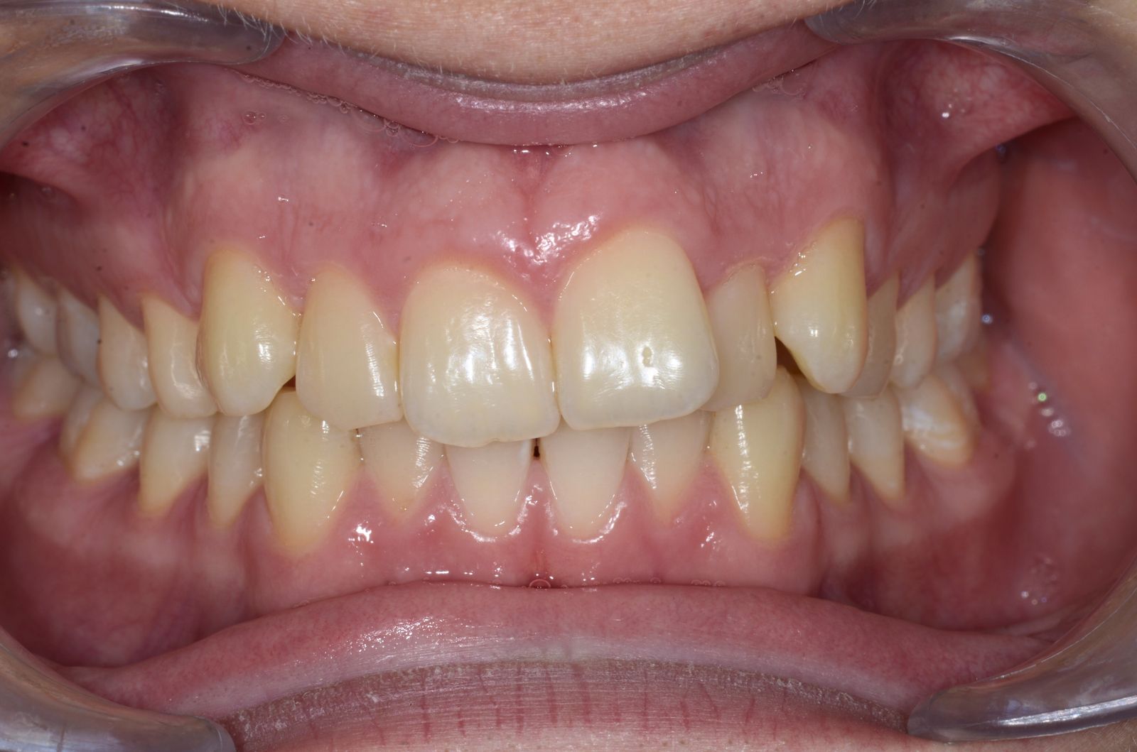 Breketai — atvejis 8