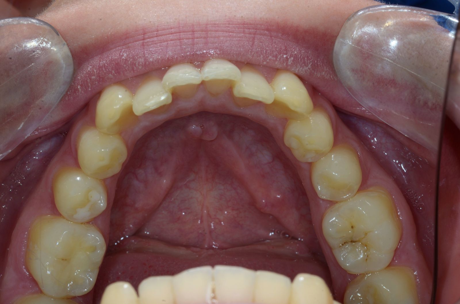 Breketai — atvejis 8