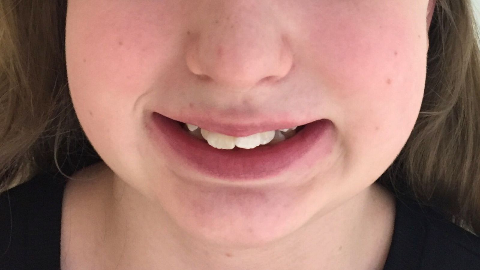 Breketai — atvejis 9