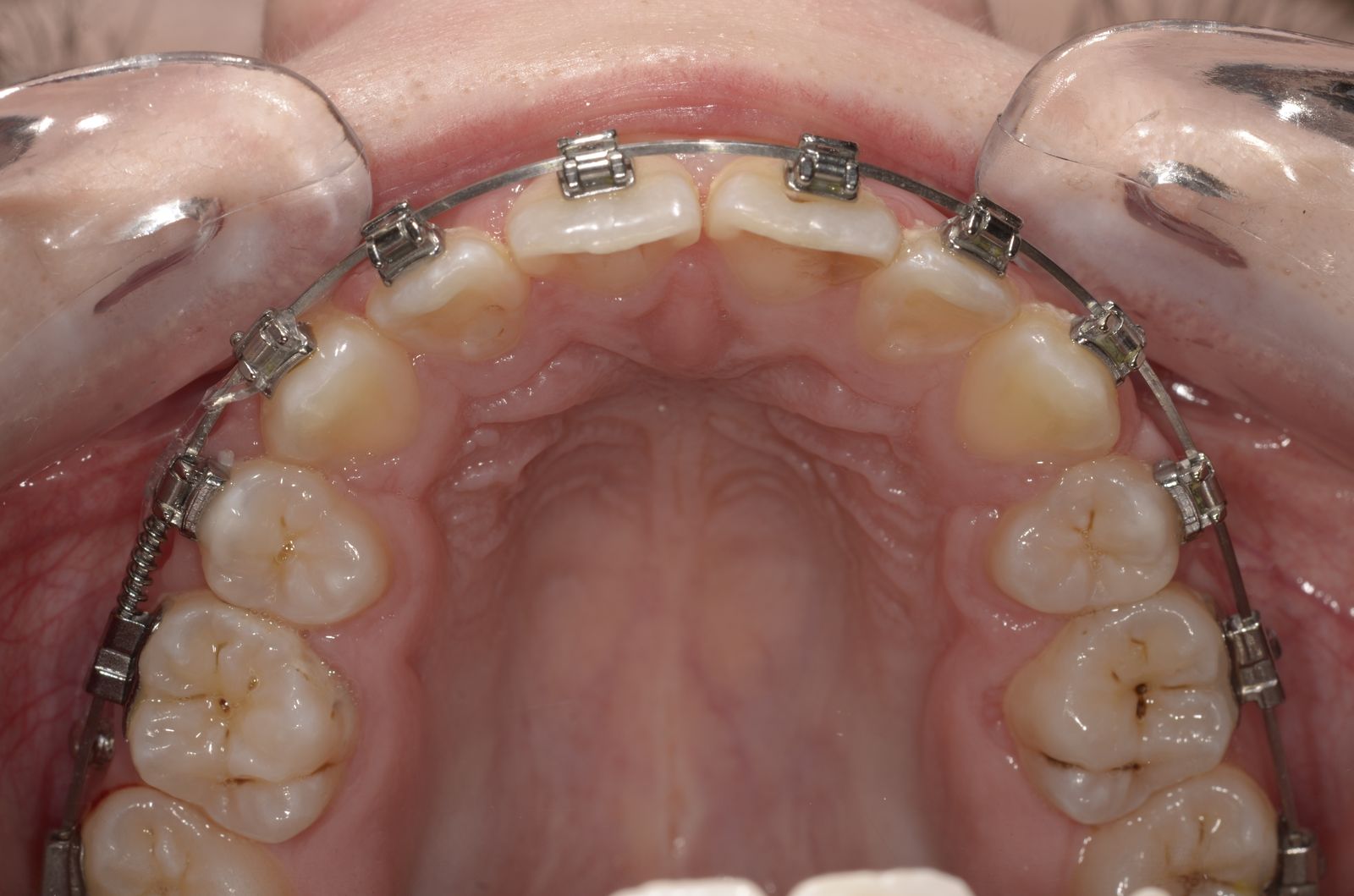 Breketai — atvejis 9