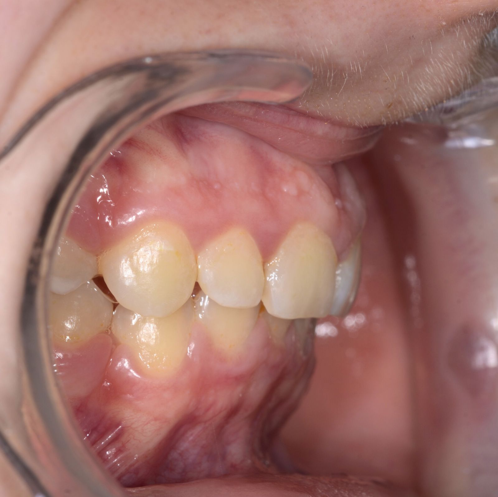 Breketai — atvejis 9