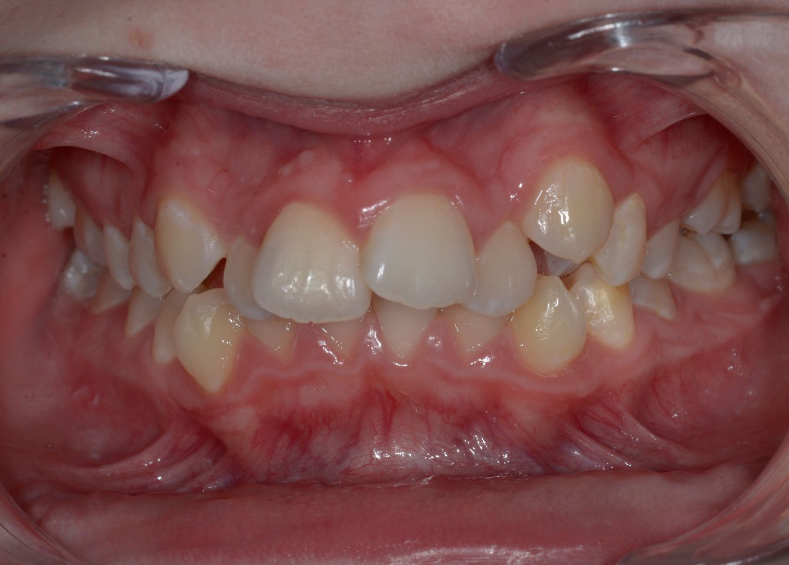 Breketai — atvejis 9