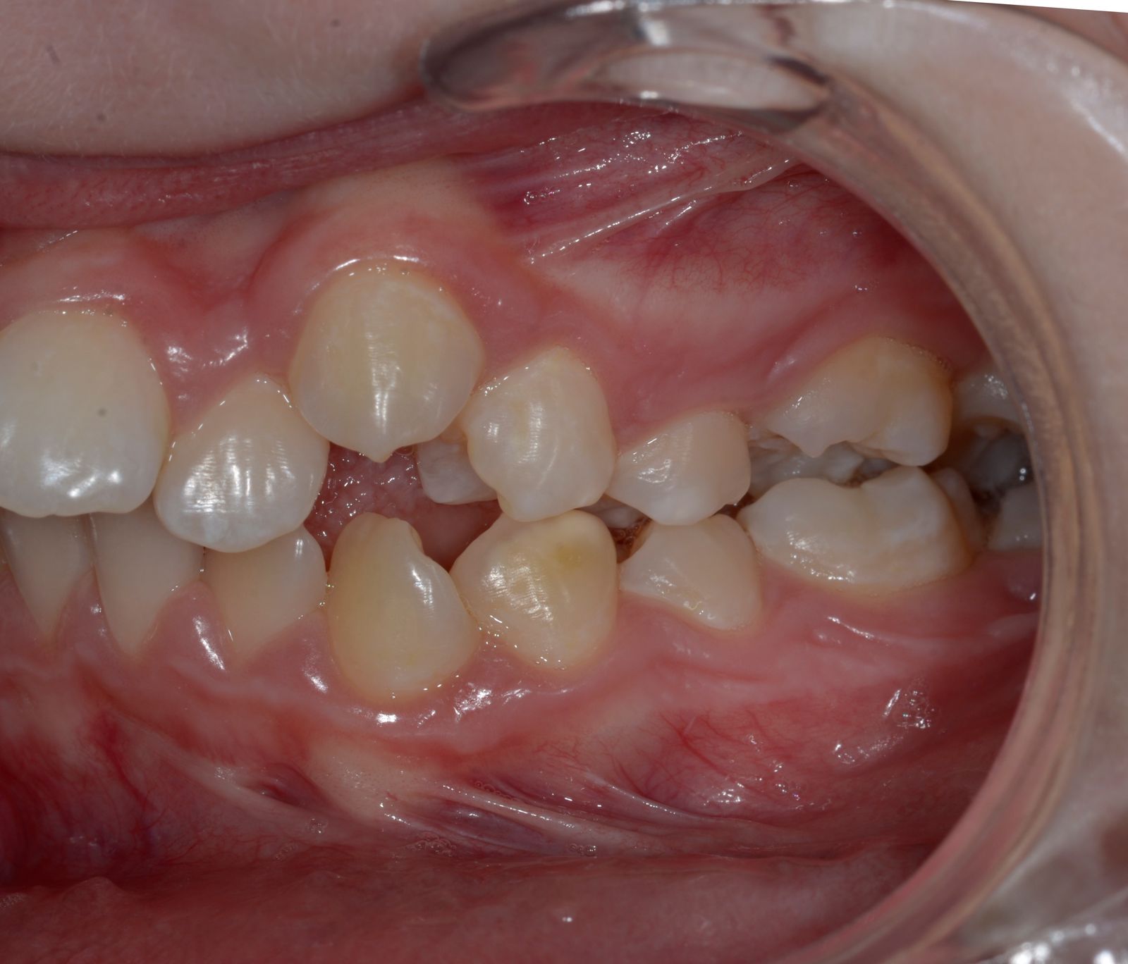 Breketai — atvejis 9