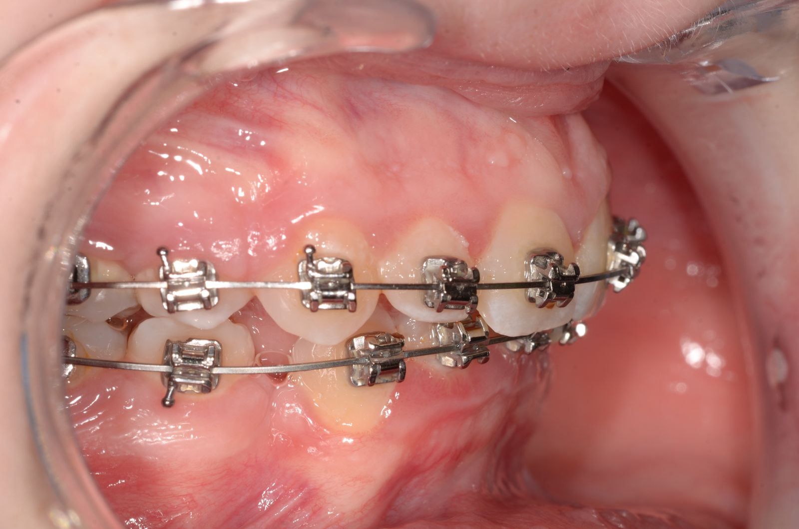 Breketai — atvejis 9