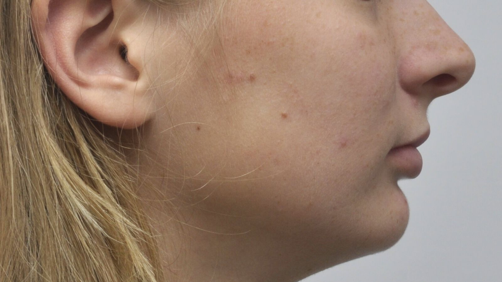 Breketai — atvejis 3