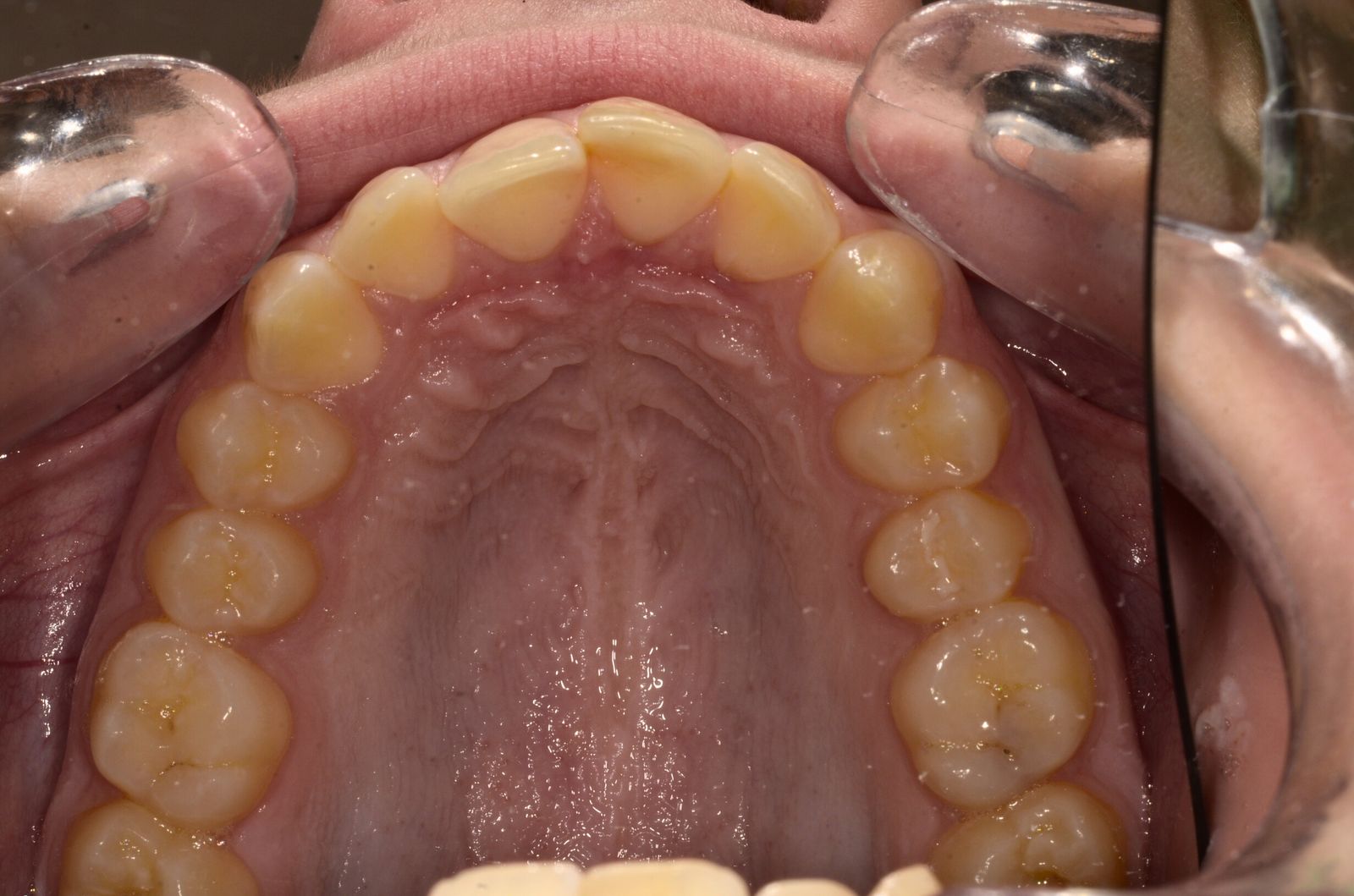 Breketai — atvejis 3