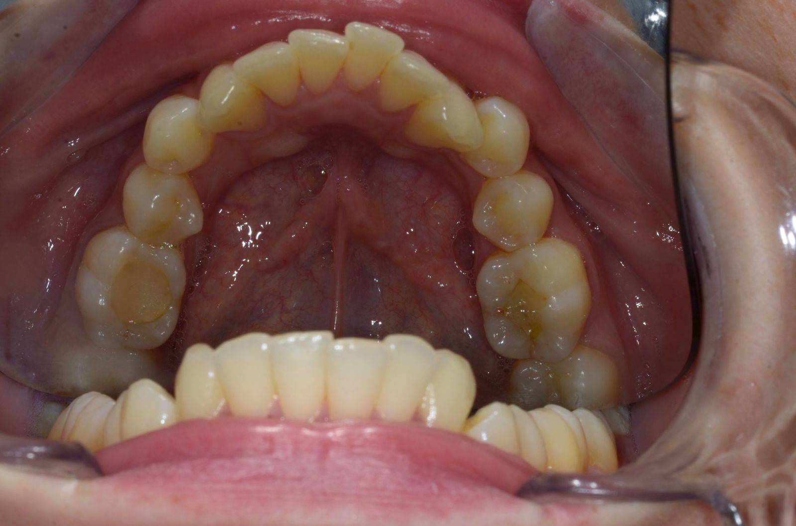 Breketai — atvejis 4