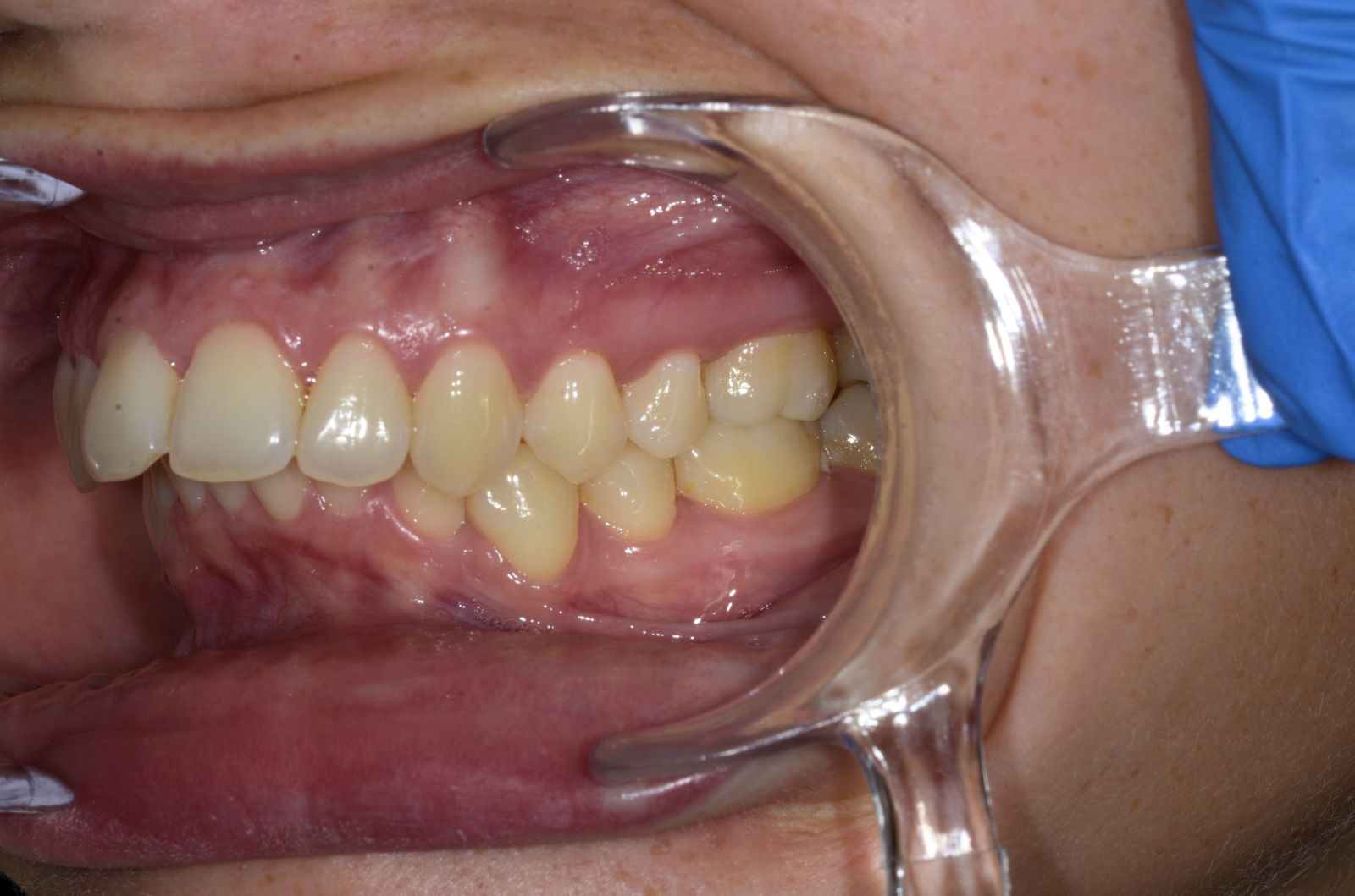 Breketai — atvejis 4