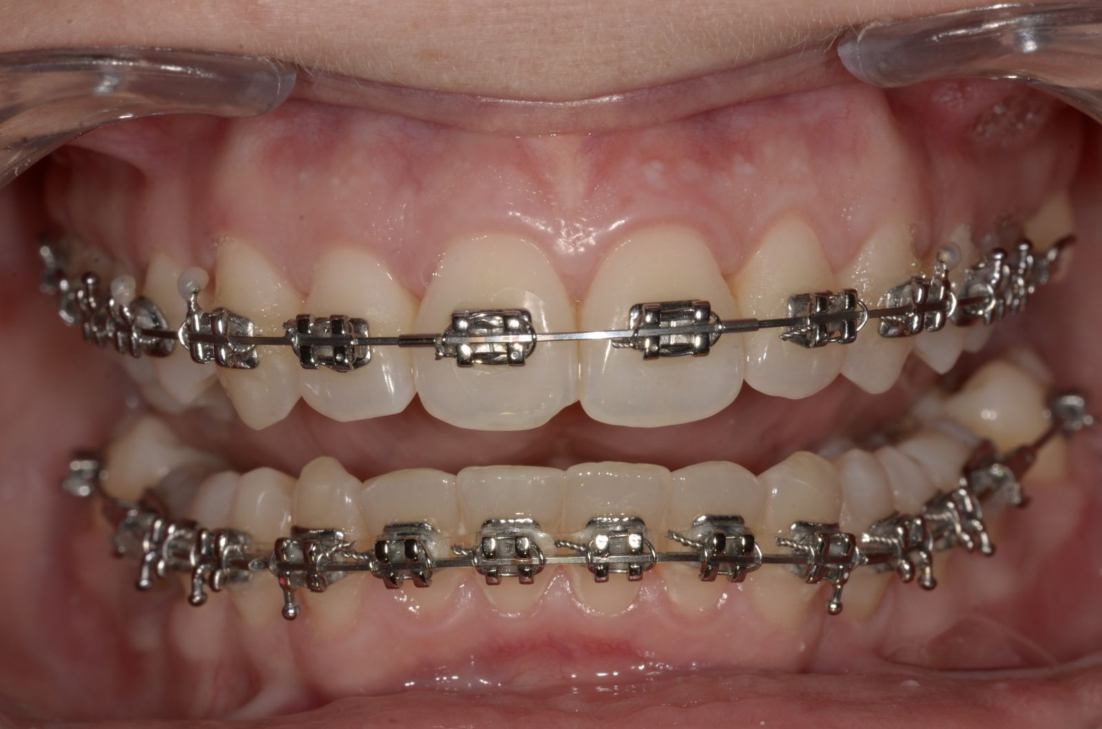 Breketai — atvejis 4