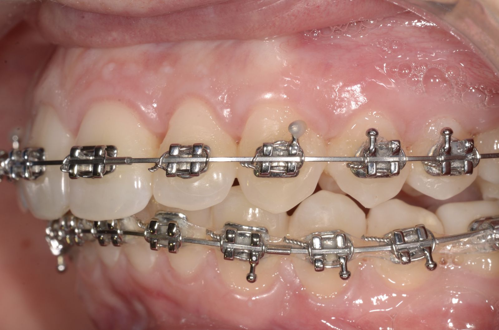 Breketai — atvejis 4