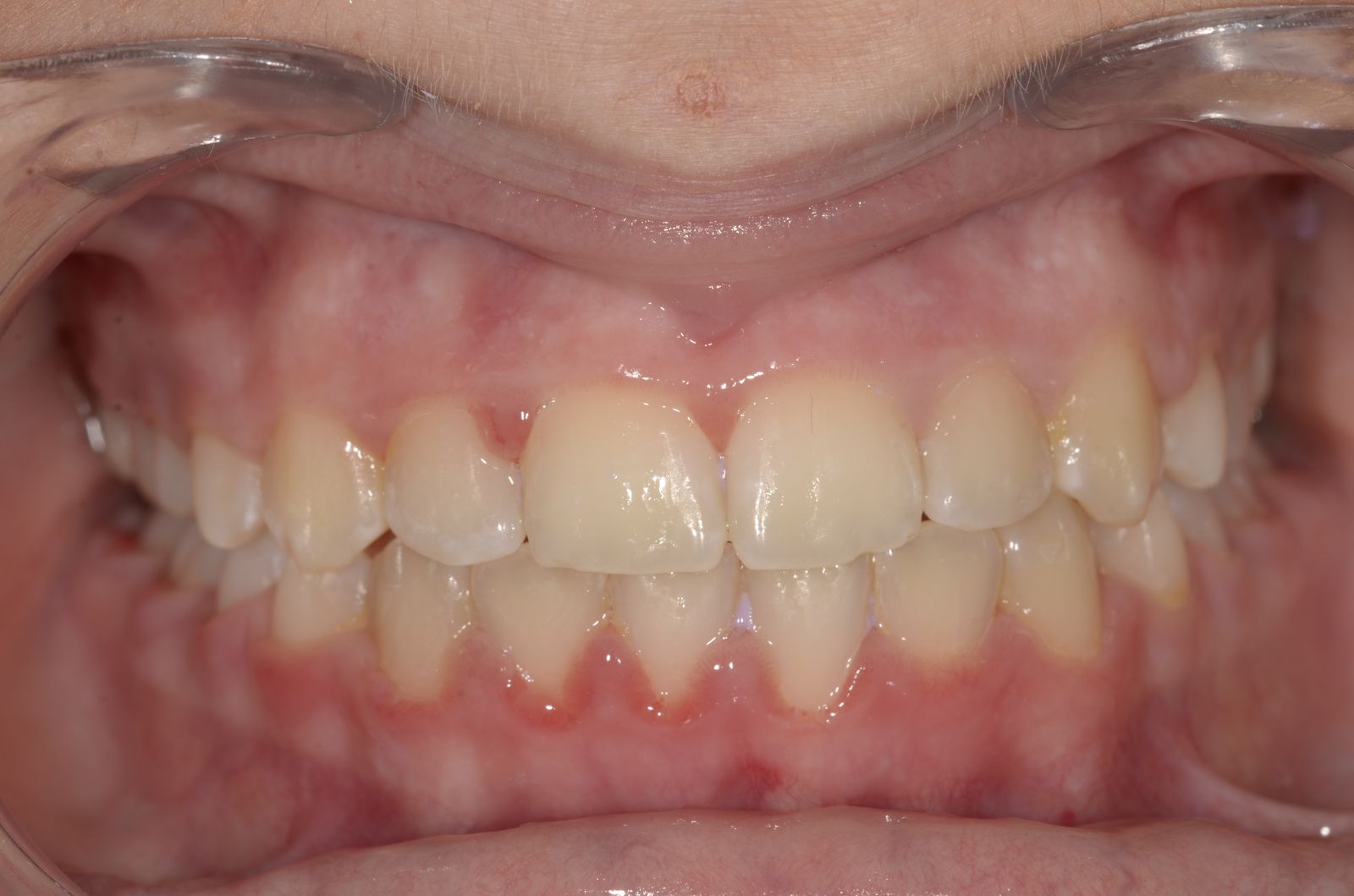 Breketai — atvejis 5