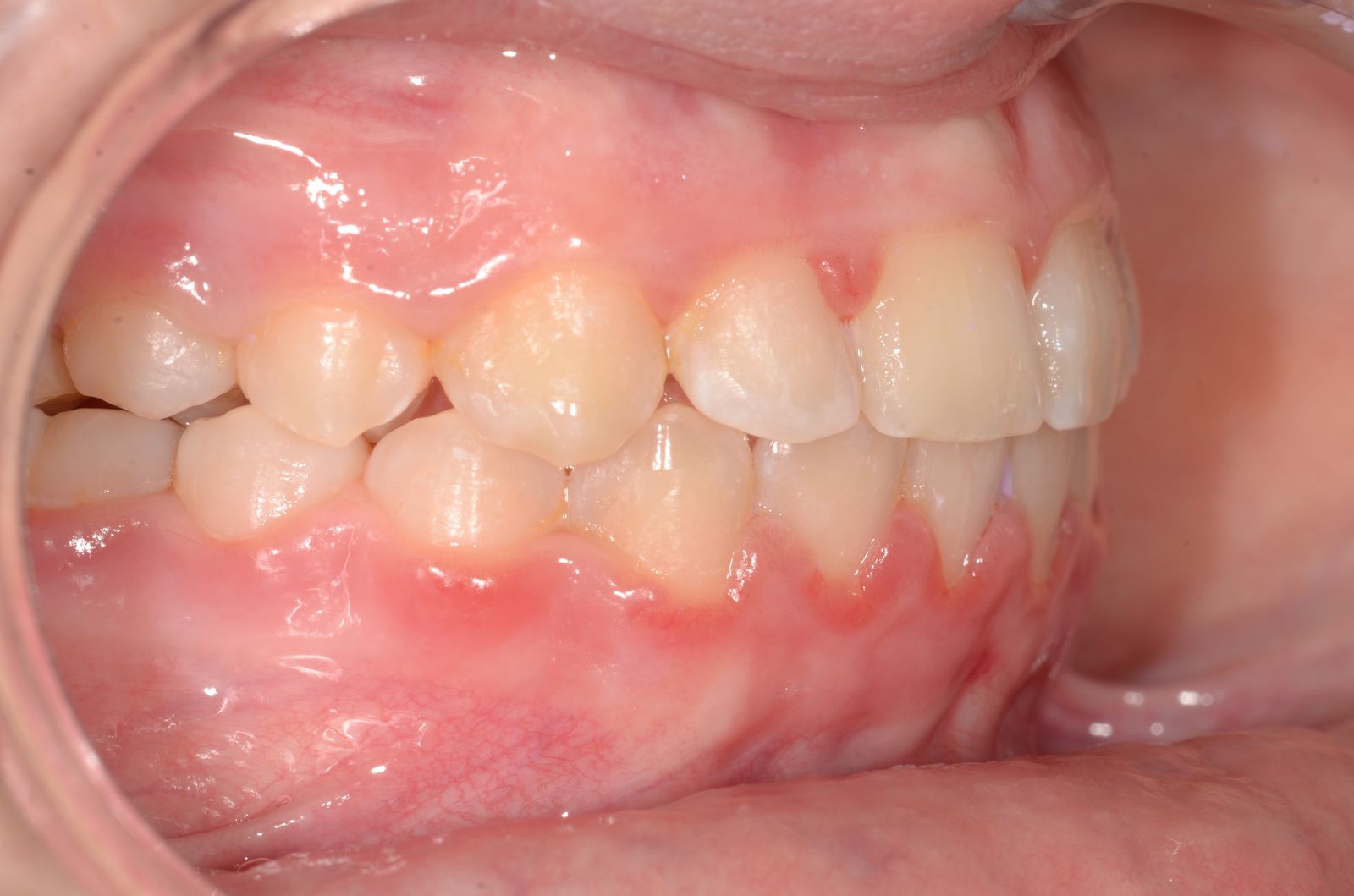 Breketai — atvejis 5