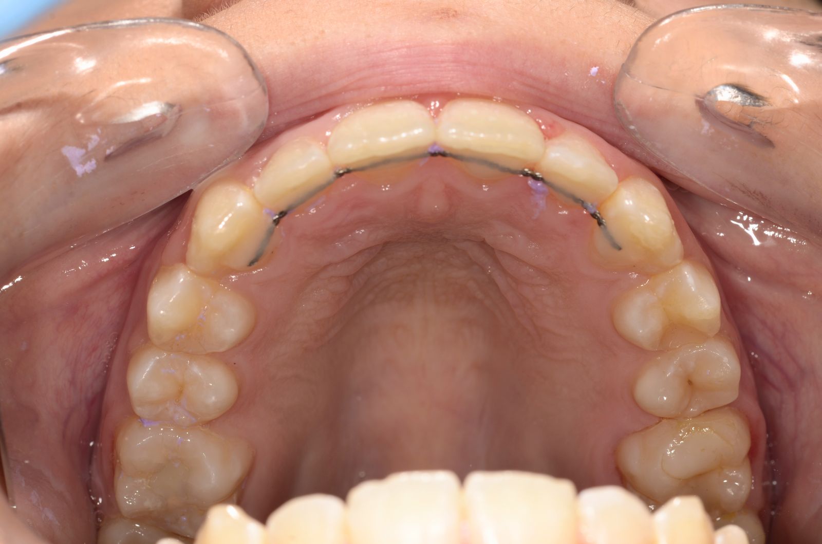 Breketai — atvejis 5