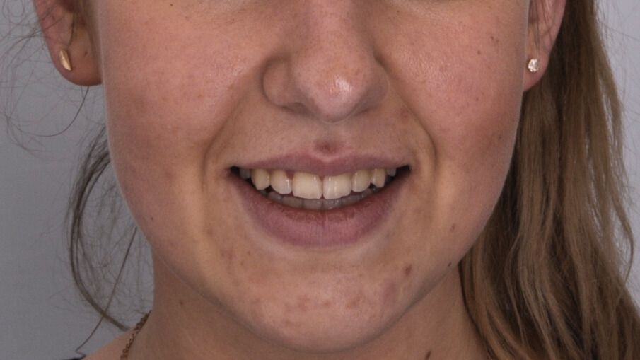 Breketai — atvejis 5