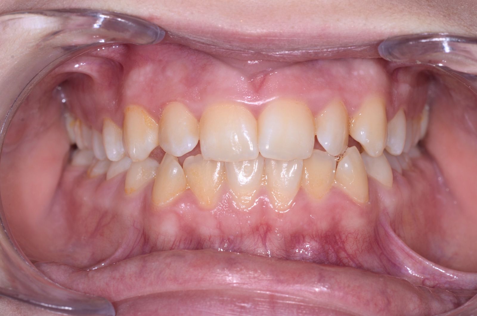 Breketai — atvejis 5