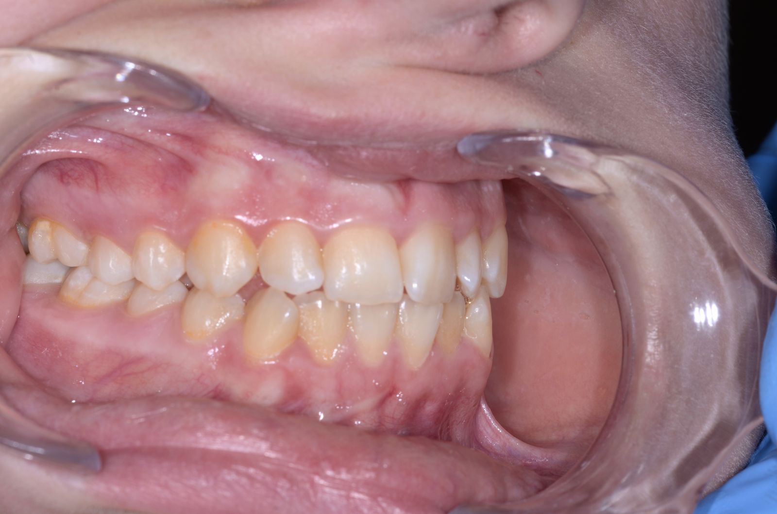 Breketai — atvejis 5