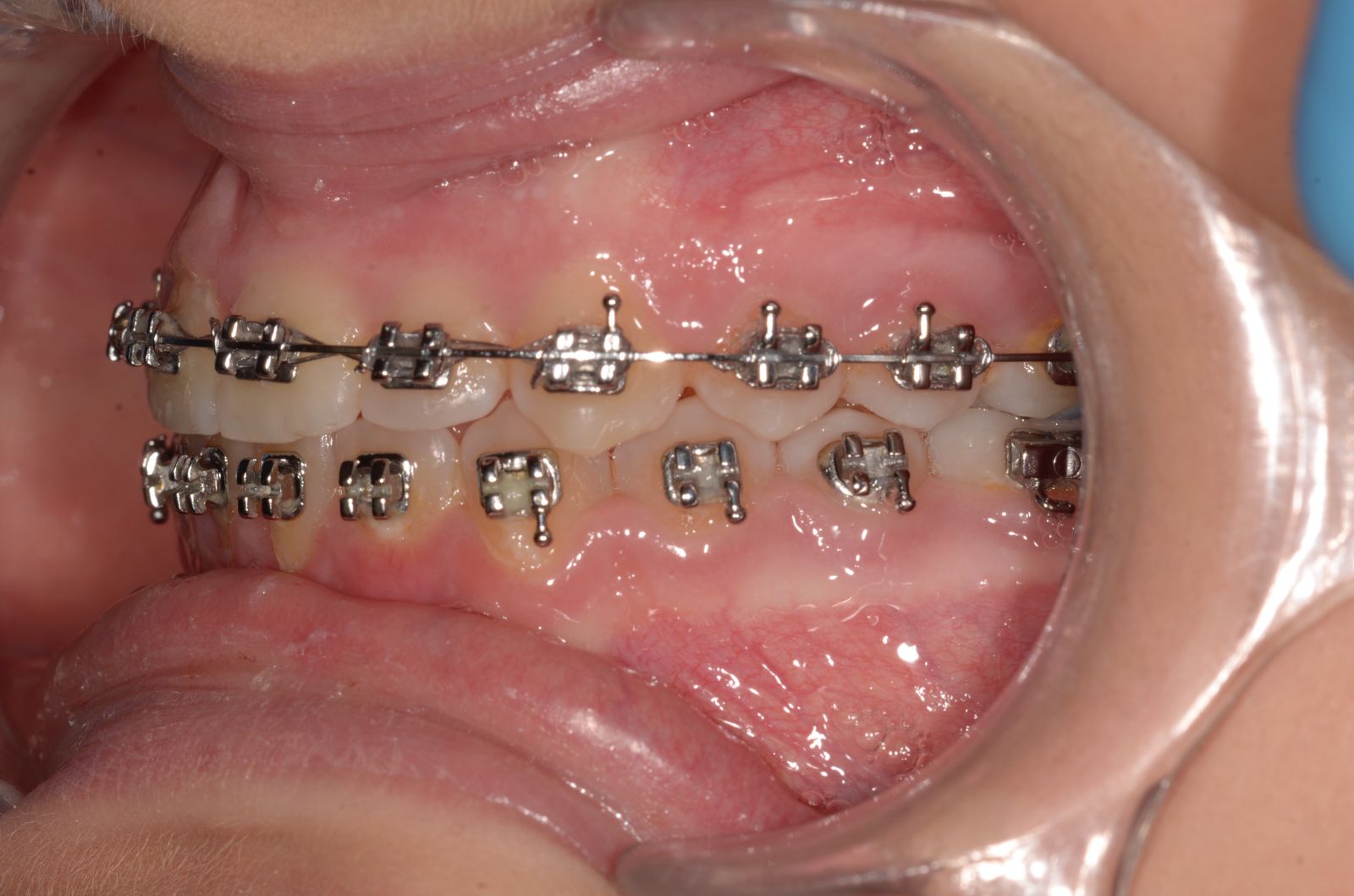 Breketai — atvejis 5