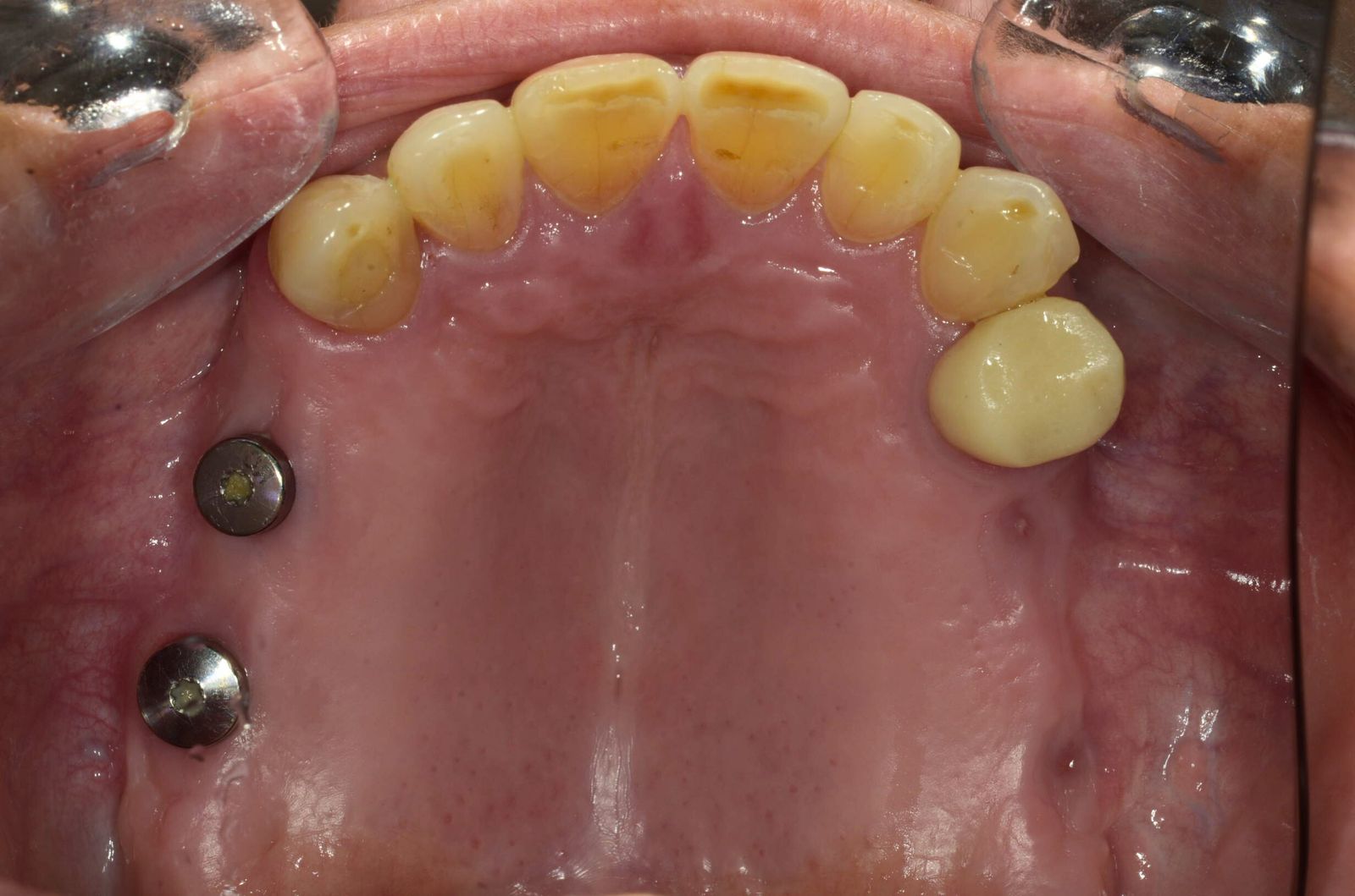 Breketai — atvejis 6