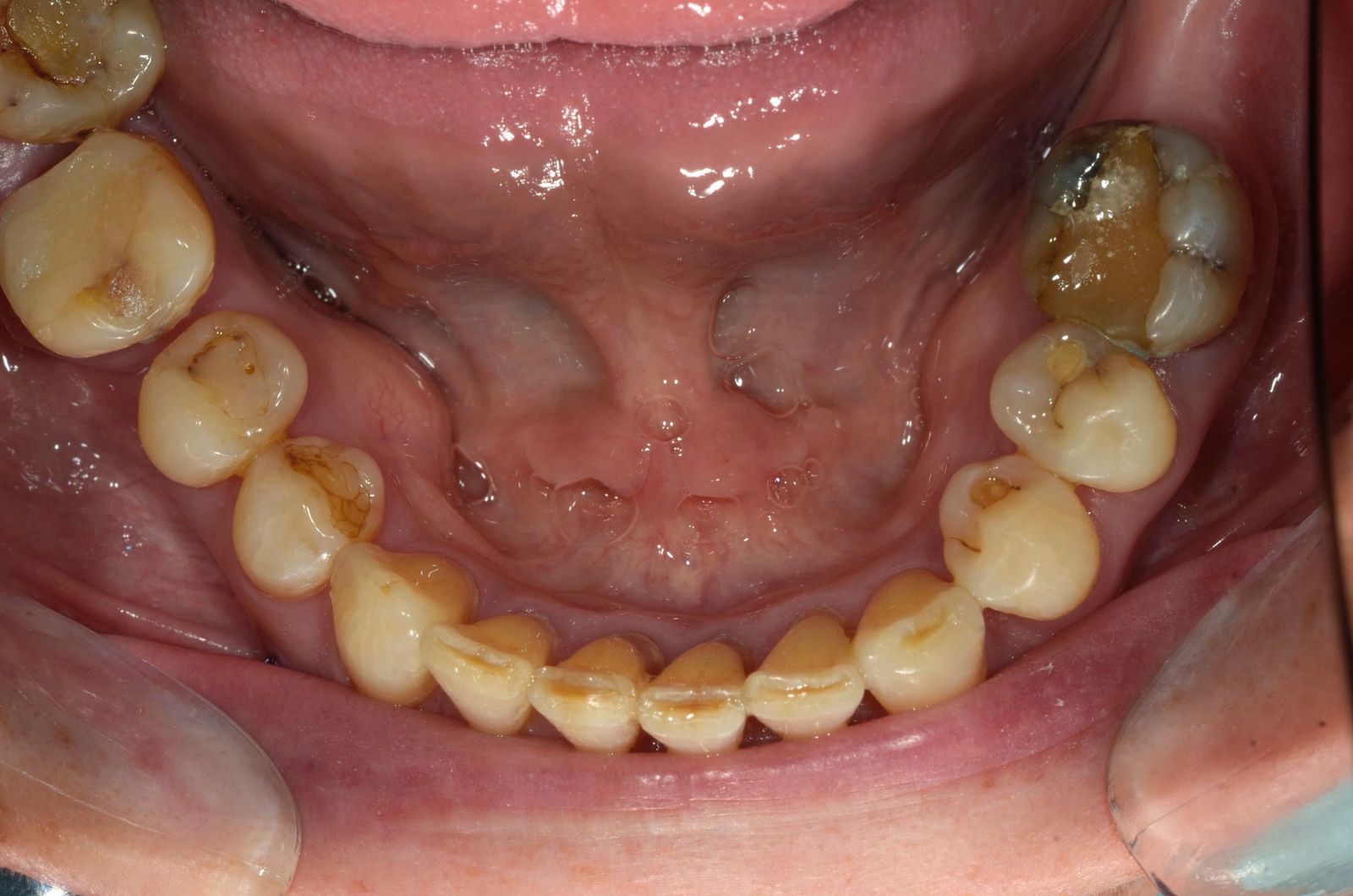 Breketai — atvejis 6