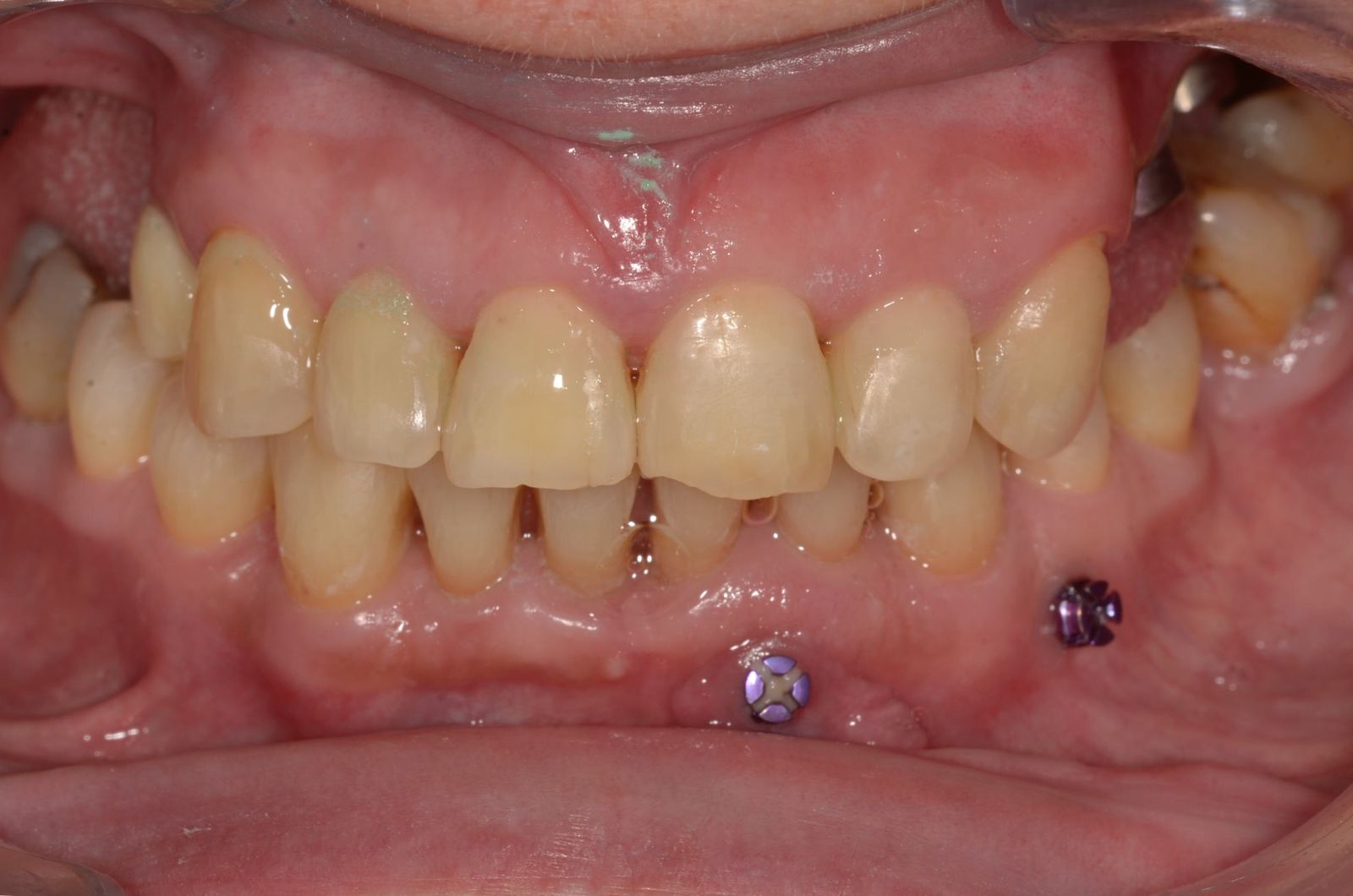 Breketai — atvejis 6