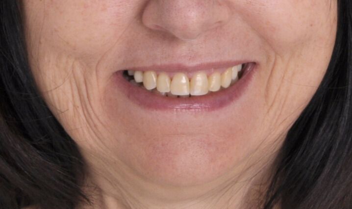 Breketai — atvejis 6