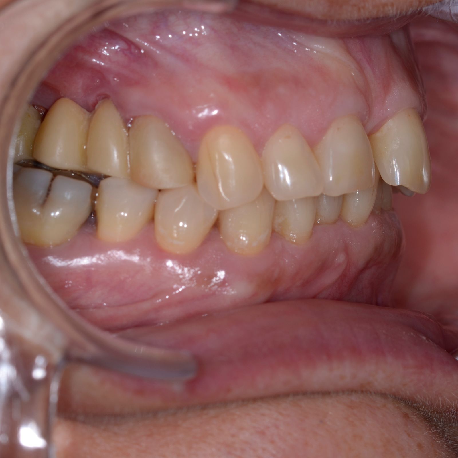 Breketai — atvejis 6