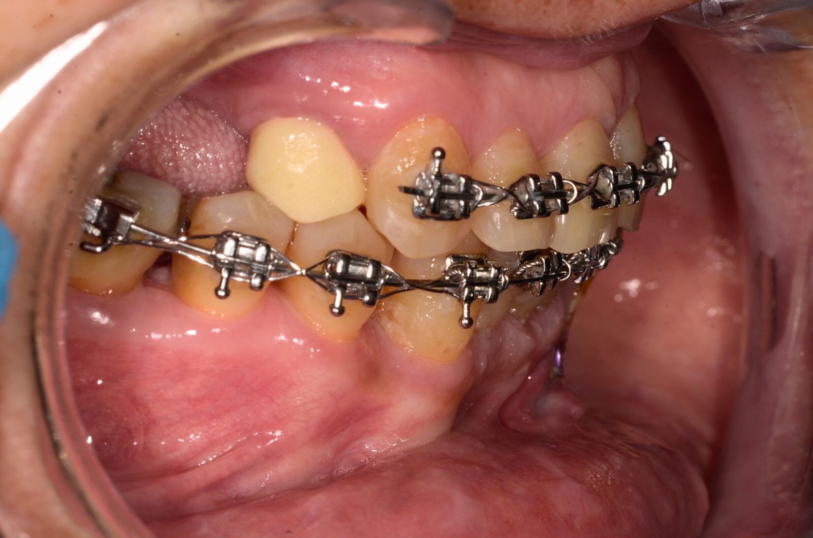 Breketai — atvejis 6