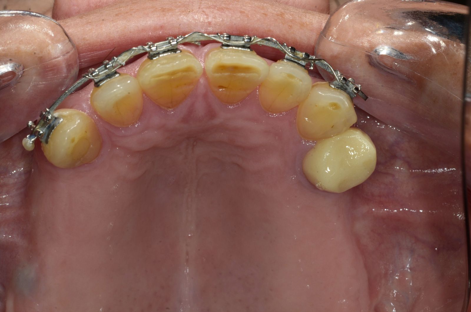 Breketai — atvejis 6