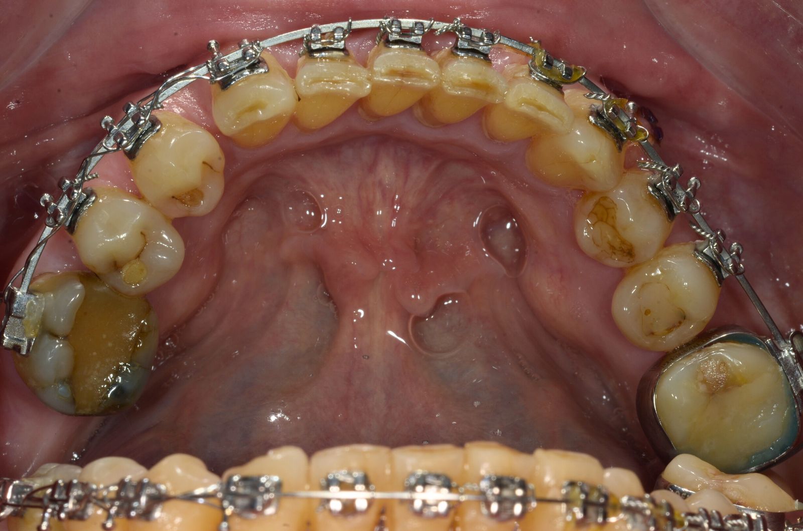 Breketai — atvejis 6