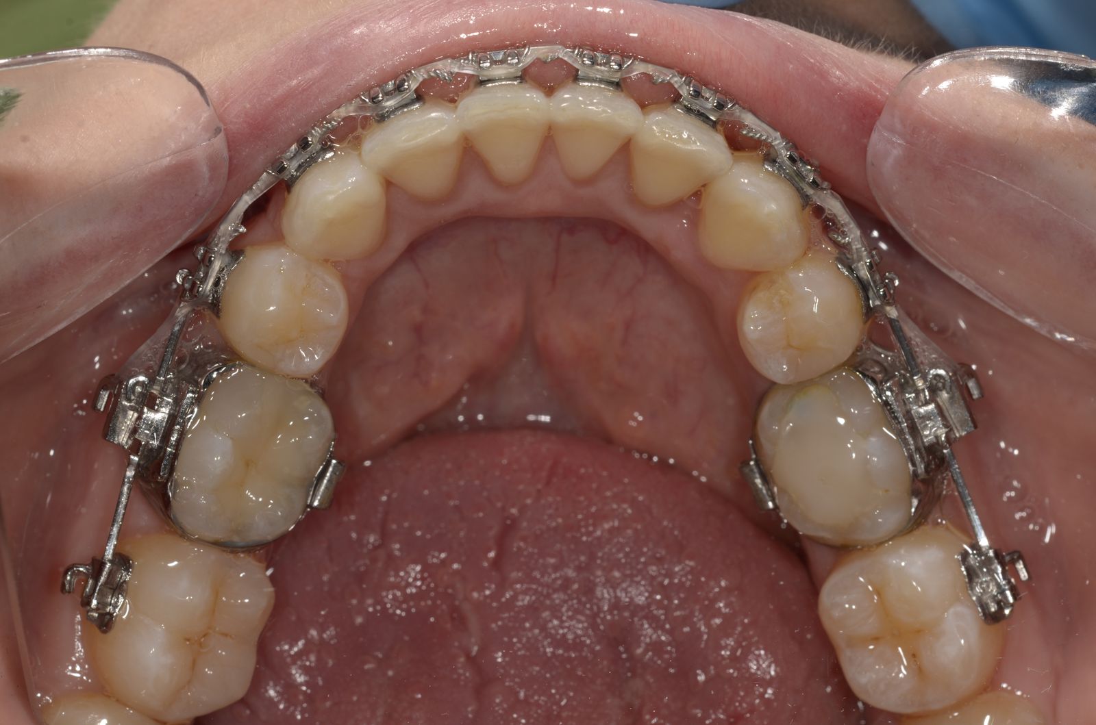 Breketai — atvejis 7