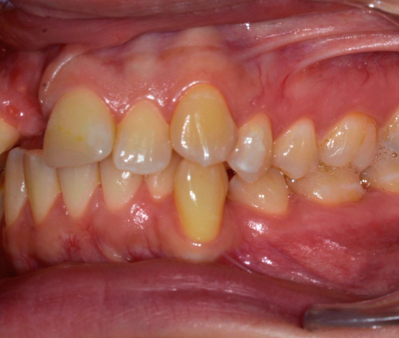 Breketai — atvejis 7