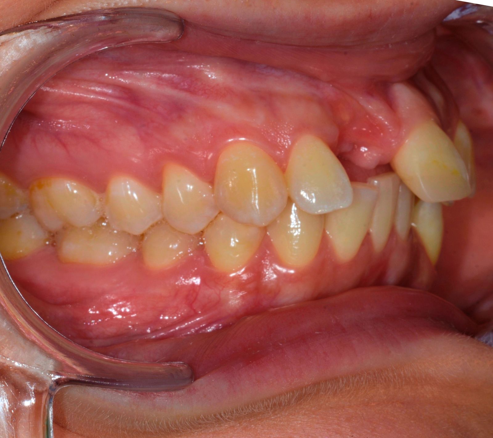 Breketai — atvejis 7