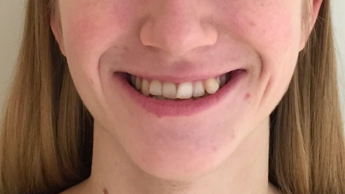 Breketai — atvejis 10