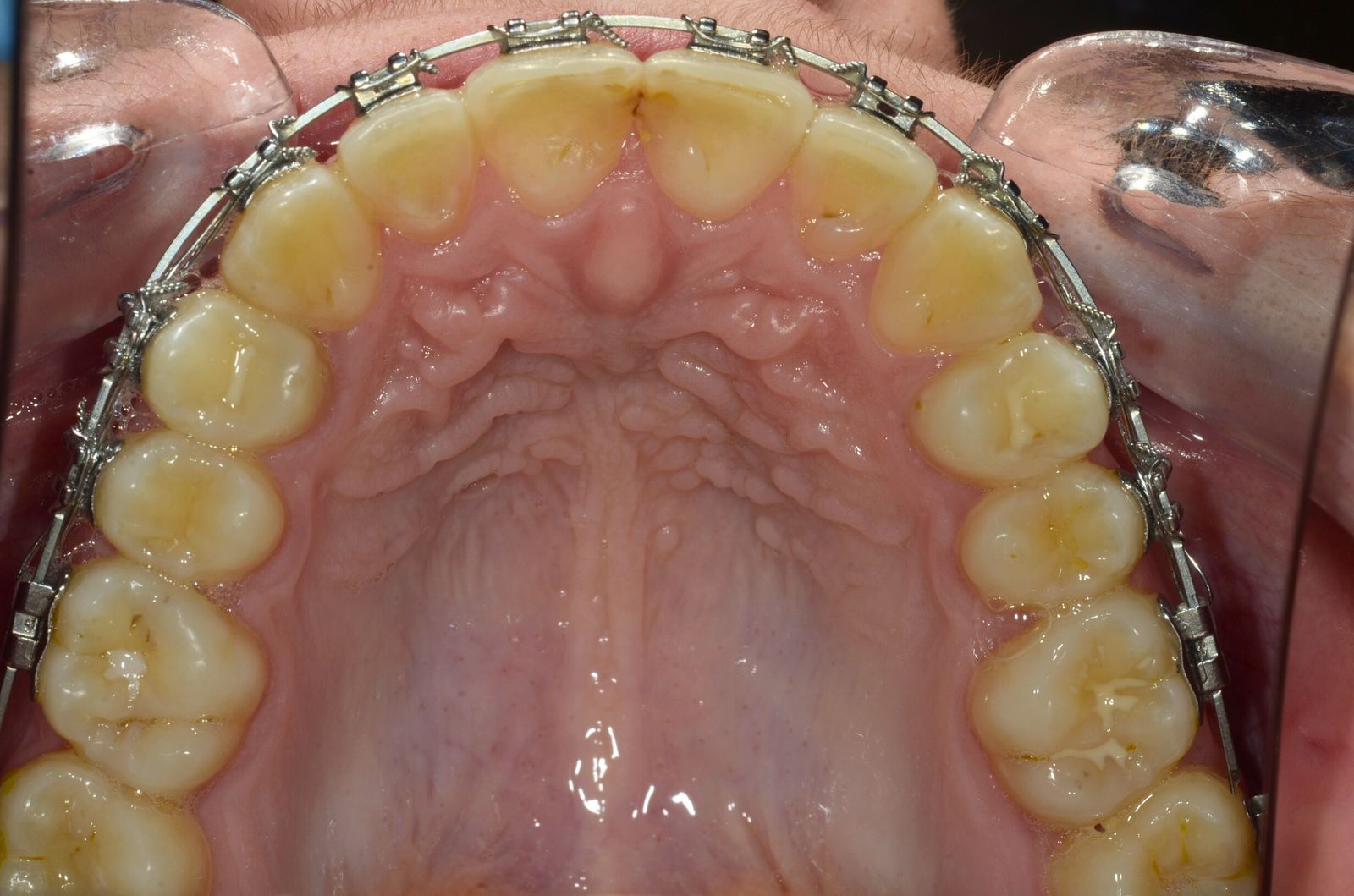 Breketai — atvejis 10