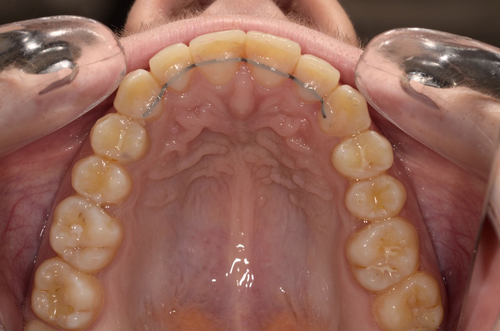 Breketai — atvejis 10