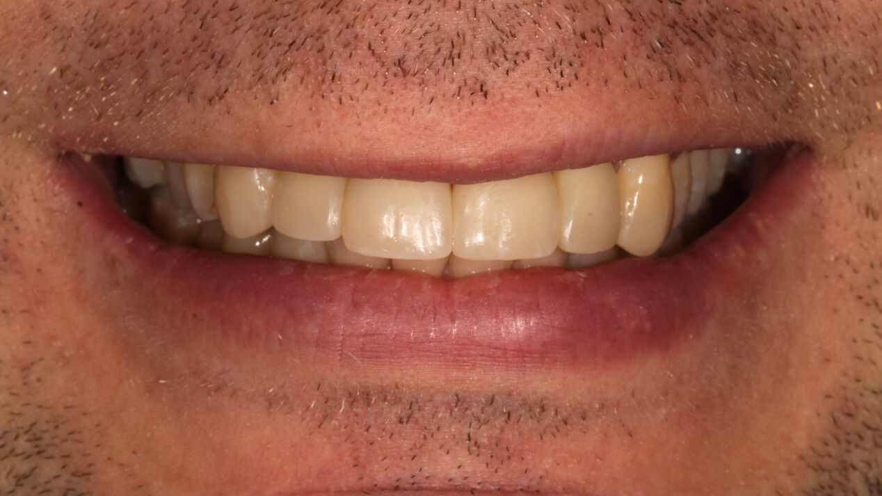 Estetinis plombavimas — atvejis 1