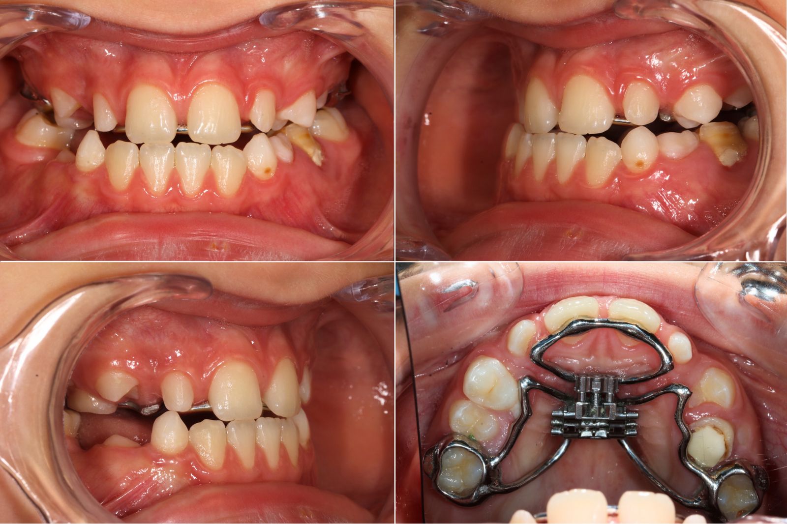 Greito plėtimo gomurio aparatas